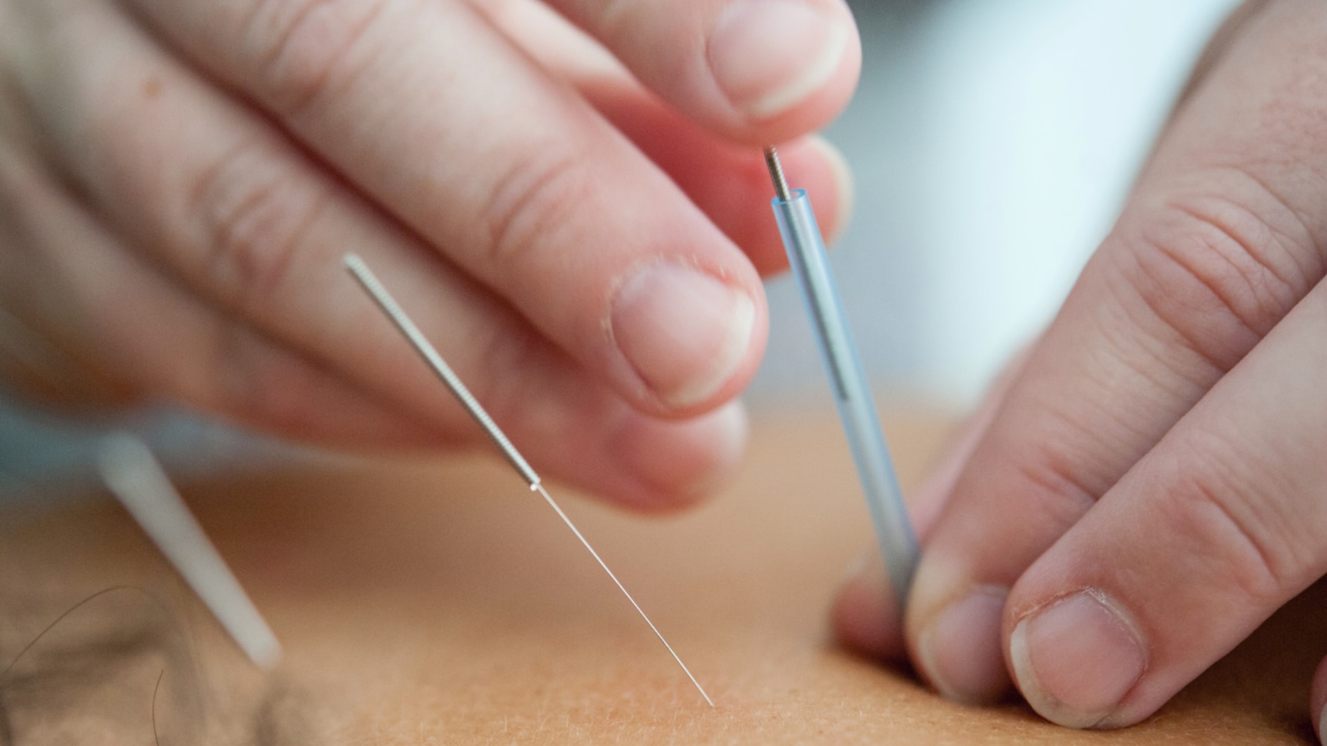 Piaget abre inscrições para Curso para Acupunctores